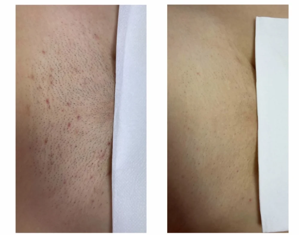 Individuální příklad výsledku laserové epilace po 5 ošetřeních