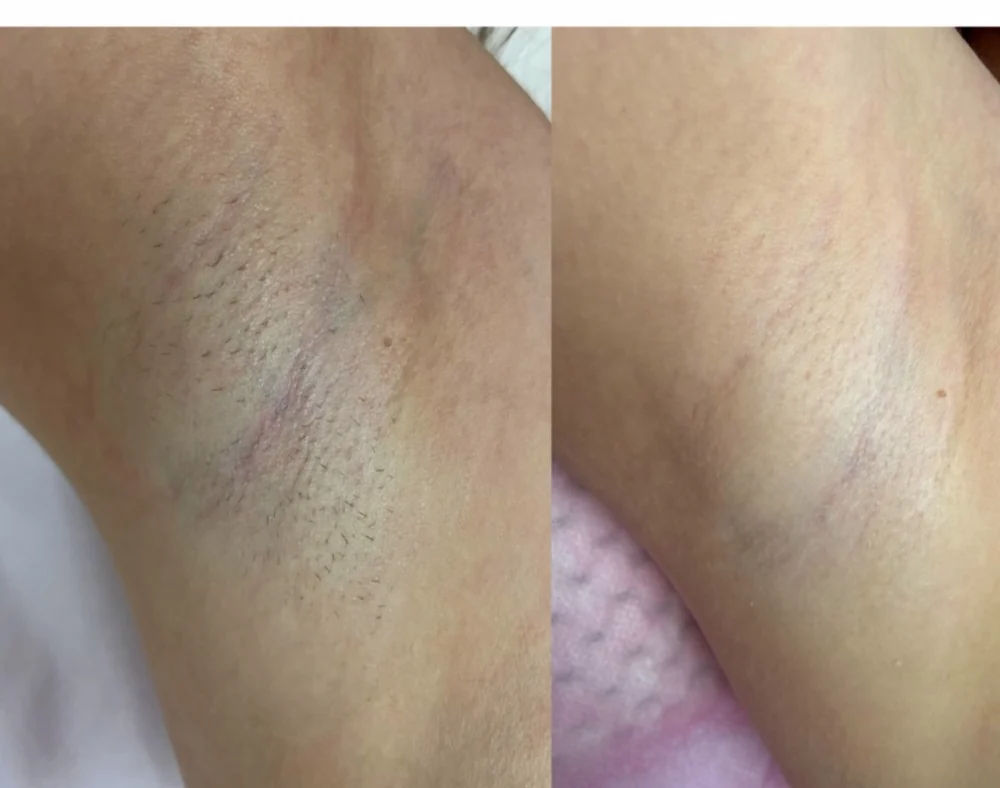 Individuální příklad výsledku laserové epilace po 6 ošetřeních