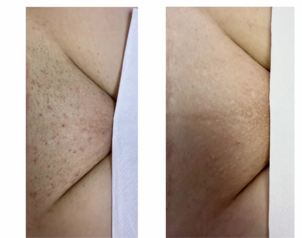 Individuální příklad výsledku laserové epilace po 6 ošetřeních